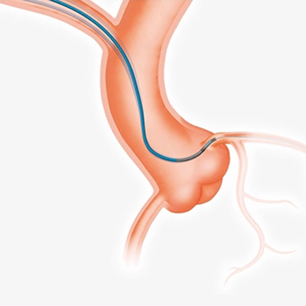 Guiding-Catheter55